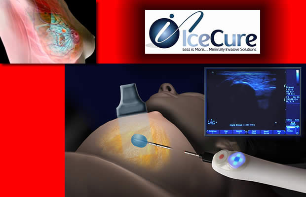 izrael IceCure Medical