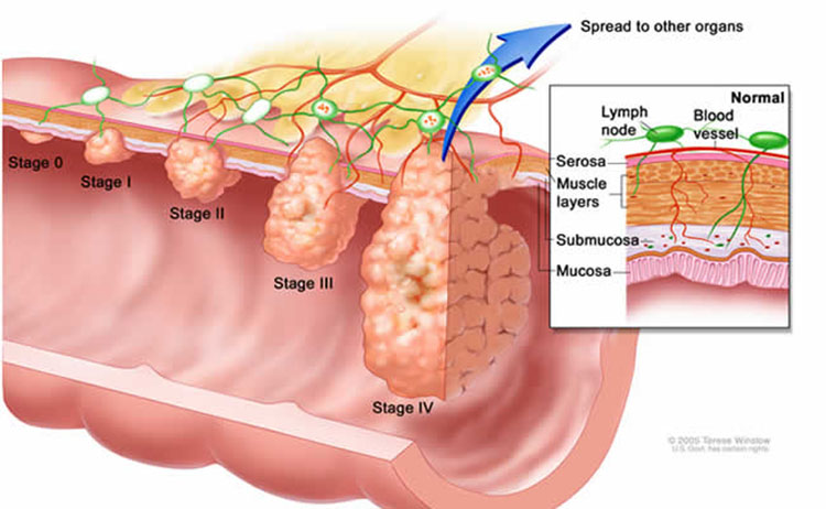 cancer stage