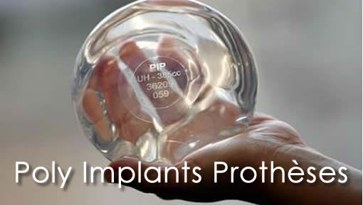 Poly Implants Prothses